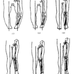 Can orthotic insoles treat o-shaped leg?