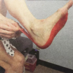 Plantar fasciitis insoles