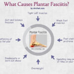 What’s a Plantar Fasciitis?