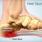 Heel Spurs: Symptoms, Causes, And Treatment