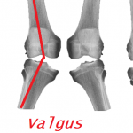 Knee Varus Orthotics