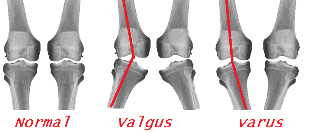 Knee Varus Orthotics