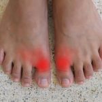 Bad Arthritic Big Toe