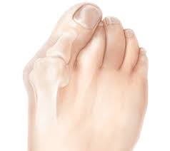 Bunions orthotics