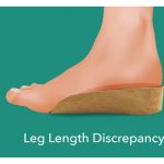 Leg Length Disparity Orthotic Insoles