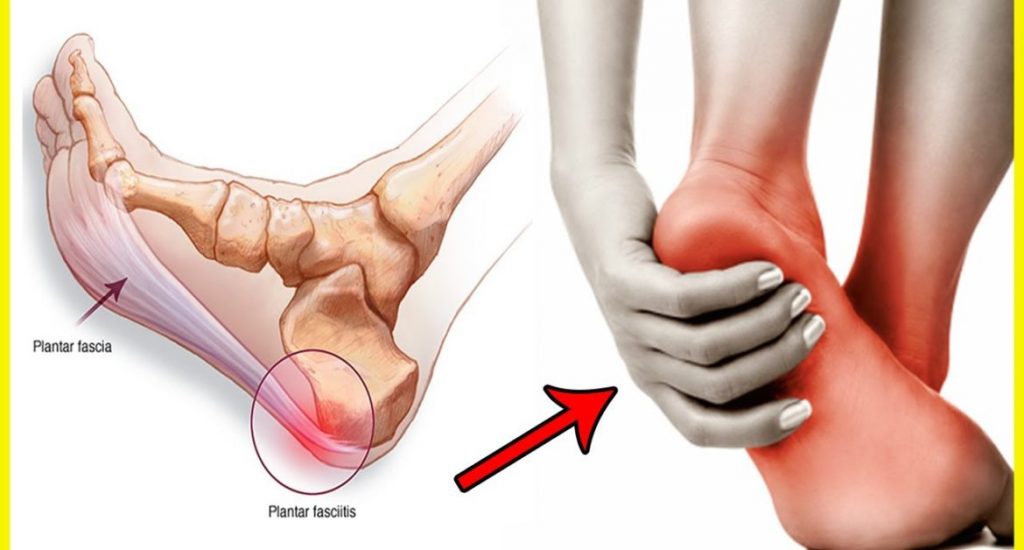 Plantar Fasciitis