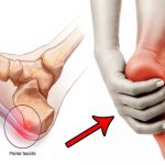 Plantar Fasciitis