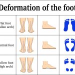 deformation of the feet