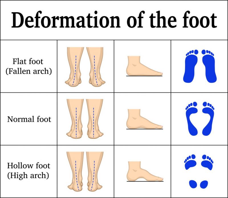 Orthotic Insoles Rehabilitation and Nursing for Common Foot Diseases