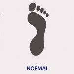 different foot type