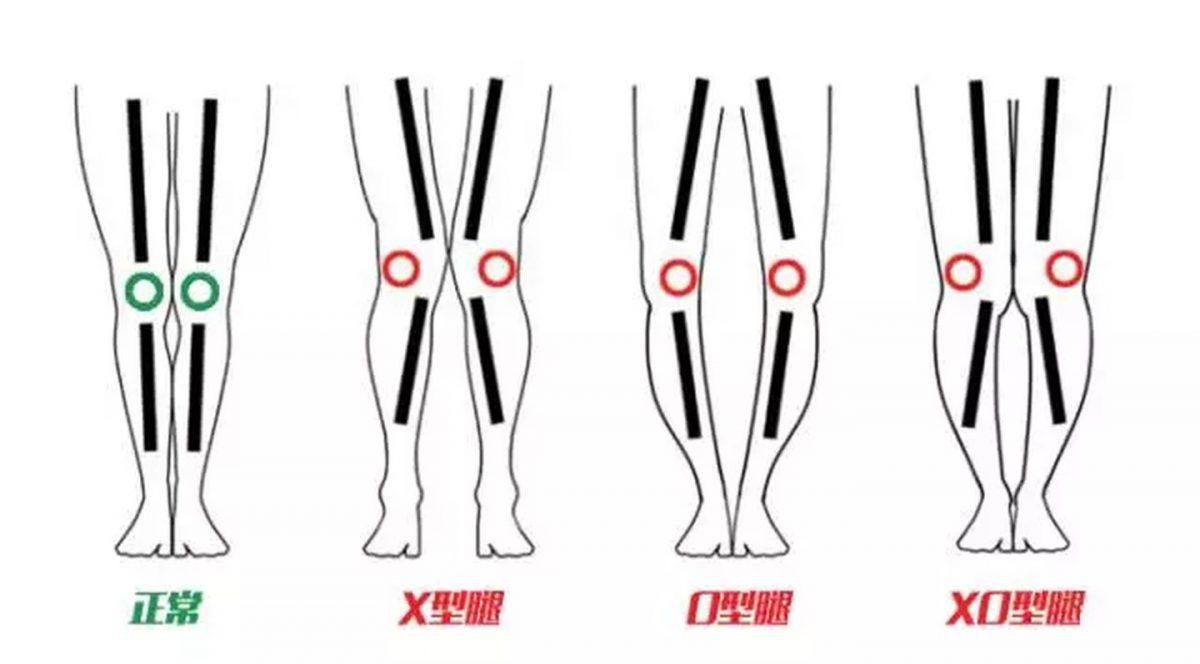 How do you know which leg type you are? EVA Orthotic Insoles Manufacturer Ideastep