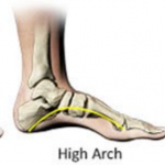 Why Can’t You Buy Orthotic Insoles at Will?