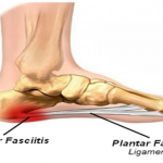Pre-made orthotics – 10 misconceptions about insoles