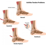 Flat foot orthotic insoles