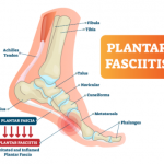 Orthotic insoles role in Several Foot Diseases