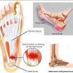 Plantar Fasciitis