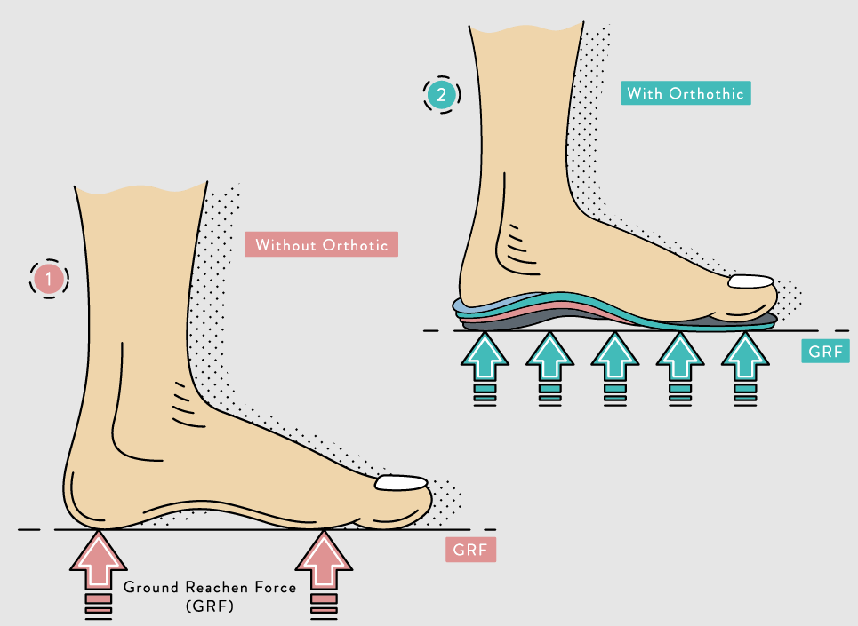 What is an Orthotic insoles