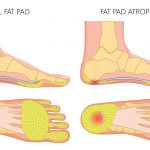 Heel Pad Syndrome