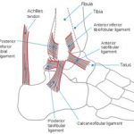 Achilles tendinitis