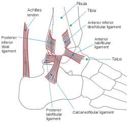 Achilles tendinitis