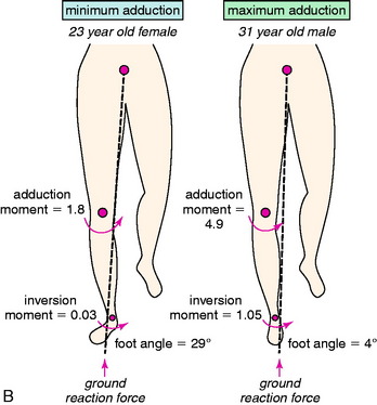 Knee Varus -- Diagnosis and Hazards | Ideastep