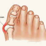 Bunion