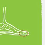 Hammer Toes
