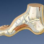High arch foot