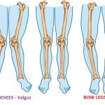 Knock-knees-Bow-Legs