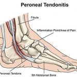 Peroneal Tendonitis
