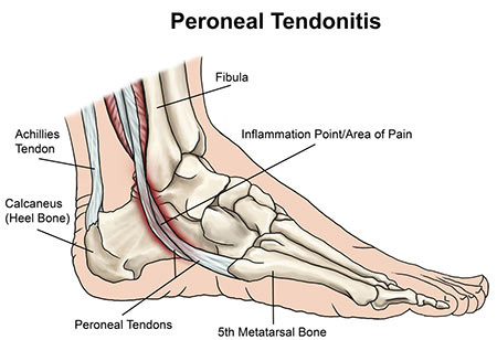 Peroneal Tendonitis