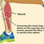 Shin Splints