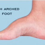 High arch foot