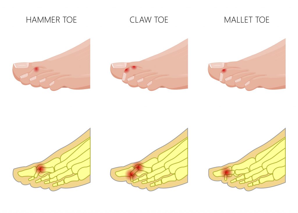 hammer-toe