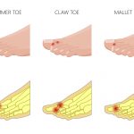 hammer-toe