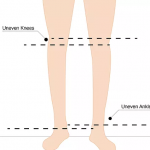 Leg Length Discrepancy
