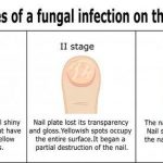 Toenail fungus