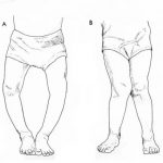 Toe-in and Toe-out