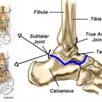 Orthotic Insolses for Foot Health Problems
