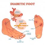 diabetic foot medical
