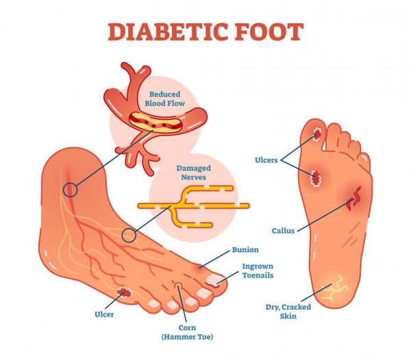 diabetic foot medical