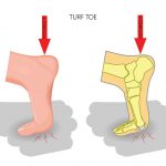 Turf Toe