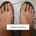 Little Toe Varus–Tailors Bunions