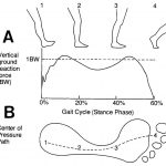 Insoles — A Timely Savior for Plantar Problems
