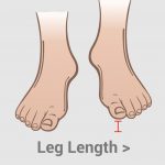The length and short feet — Leg Length Discrepancy
