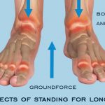 Insoles to Degenerative Arthritis — Long Time Standing