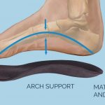 The Misunderstanding of Orthotic Insoles