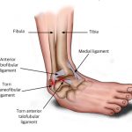 Running Ankle Pains Faintly, Should I wear an “Ankle Protector”?