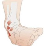 What Should I Do If I Often Sprain the Ankles?