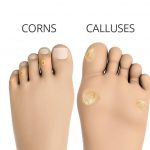 How to Get Rid of Corns on Your Feet That Hurt